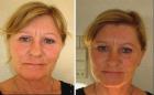 Faltenbehandlung Cellulitebehandlung Haarausfallbehandlung